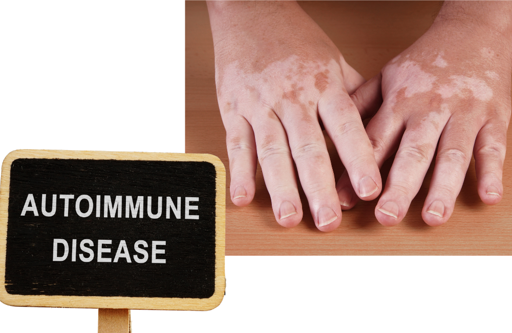 Understanding Autoimmune Disorders: Causes, Symptoms, and Treatment