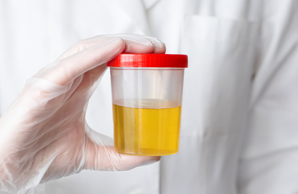 Understanding Bright Yellow Urine: Causes, Symptoms, and Solutions