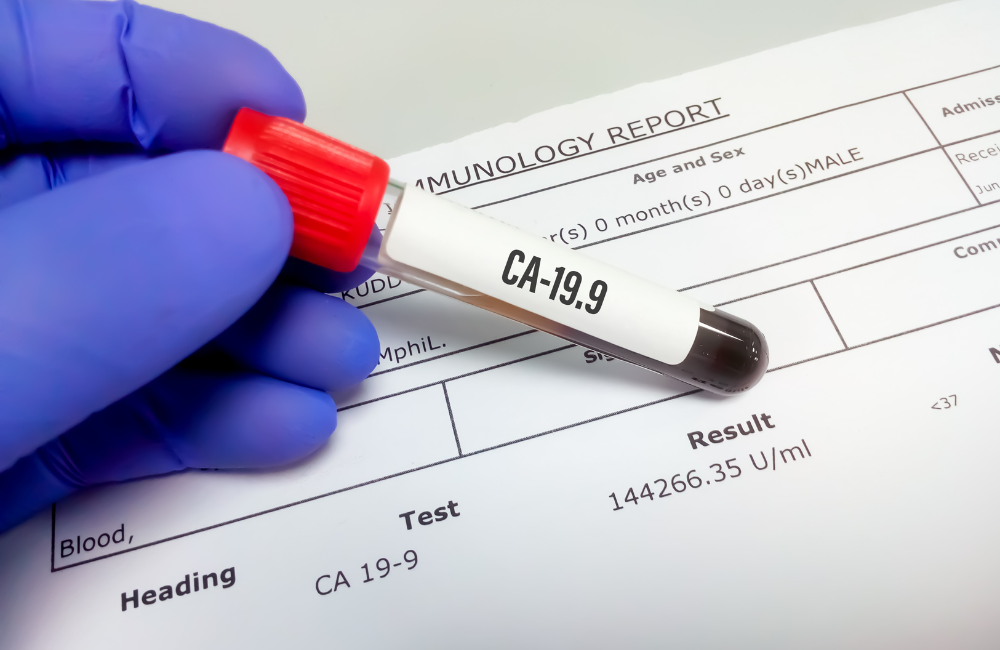 Ca 19 9 Blood Test For Pancreatic Cancer 